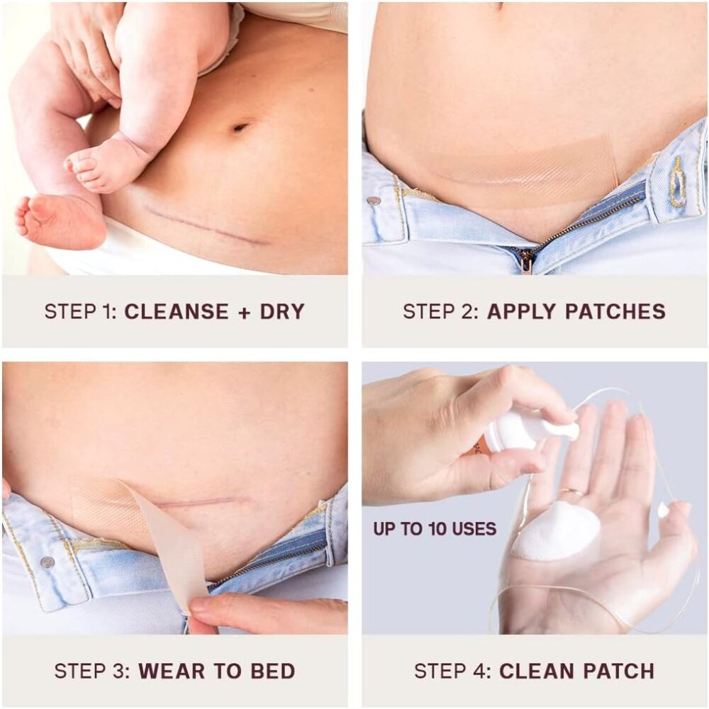 Dermaclara C-Section Patch - Picture 3 of 6
